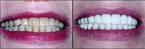 Center for Cosmetic Dentistry, Bernard Genet DDS - Clementon, NJ