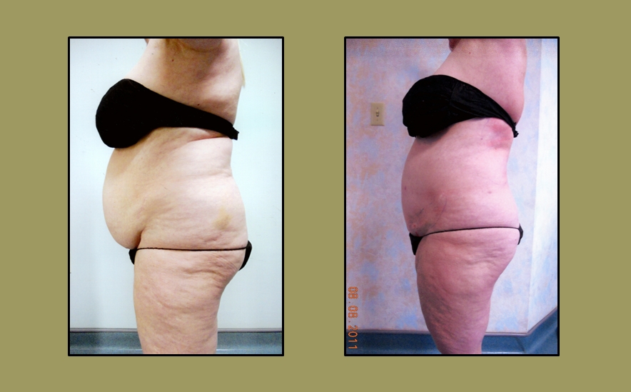 Artistic Liposculpting Center - New Port Richey, FL