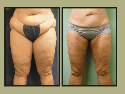 Artistic Liposculpting Center - New Port Richey, FL