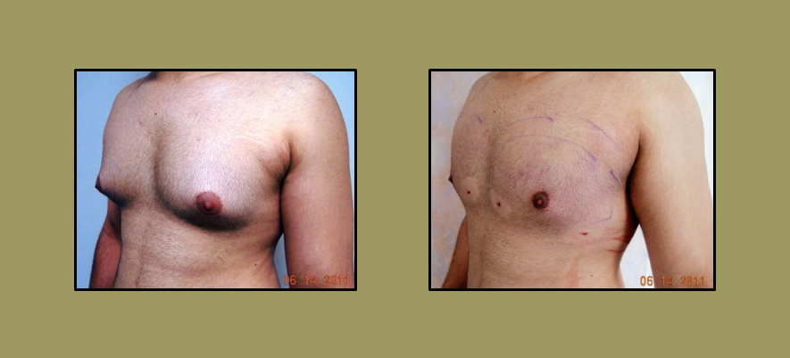 Artistic Liposculpting Center - New Port Richey, FL