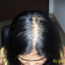 Hrc Hair Restoration Of CA - Los Angeles, CA