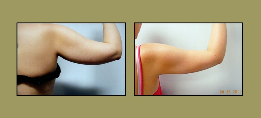 Artistic Liposculpting Center - New Port Richey, FL