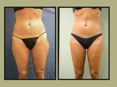 Artistic Liposculpting Center - New Port Richey, FL