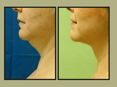 Artistic Liposculpting Center - New Port Richey, FL